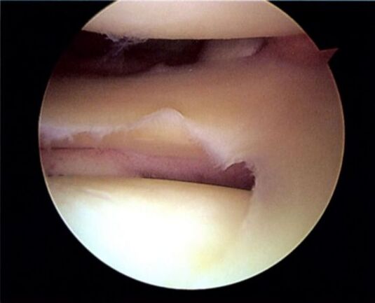 A torn meniscus leads to osteoarthritis of the knee