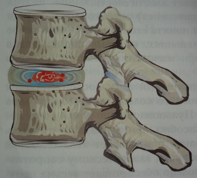 Damage to the nucleus pulposus of the intervertebral disc in the first stage of cervical osteochondrosis