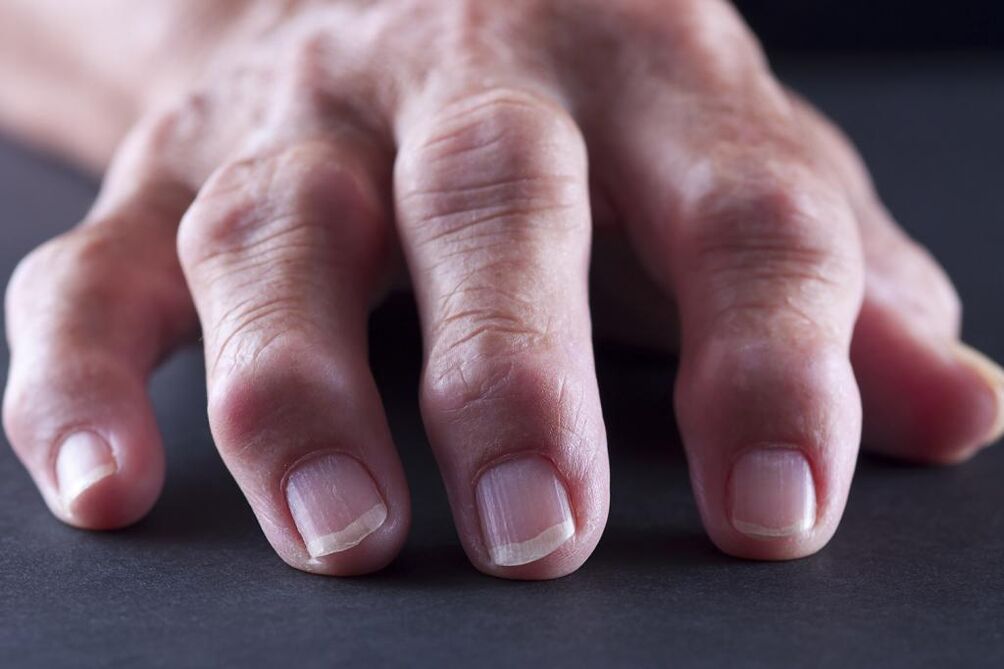 Bursitis is characterized by pain, inflammation and swelling of the finger joint