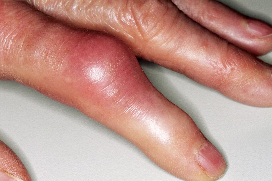 Swelling, deformation of finger joints and acute pain after injury