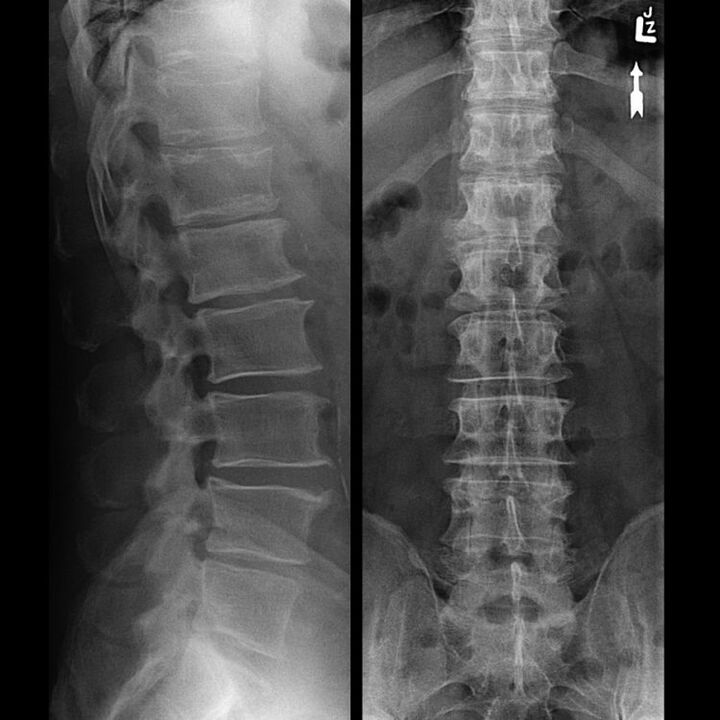 Sncing spine with osteochondrosis