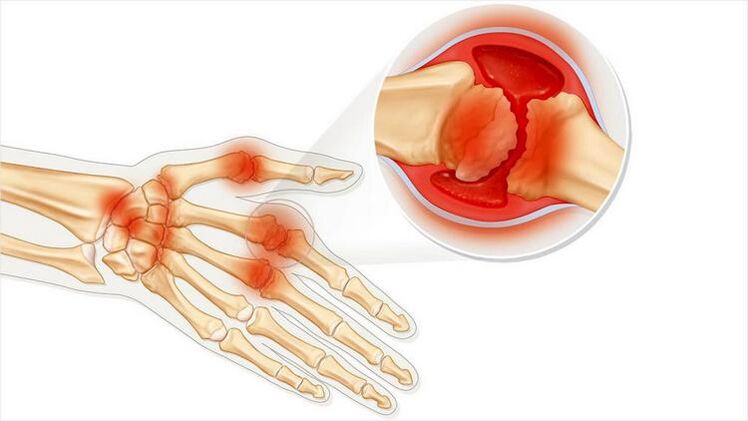 Damage to the joints of the arms due to arthritis