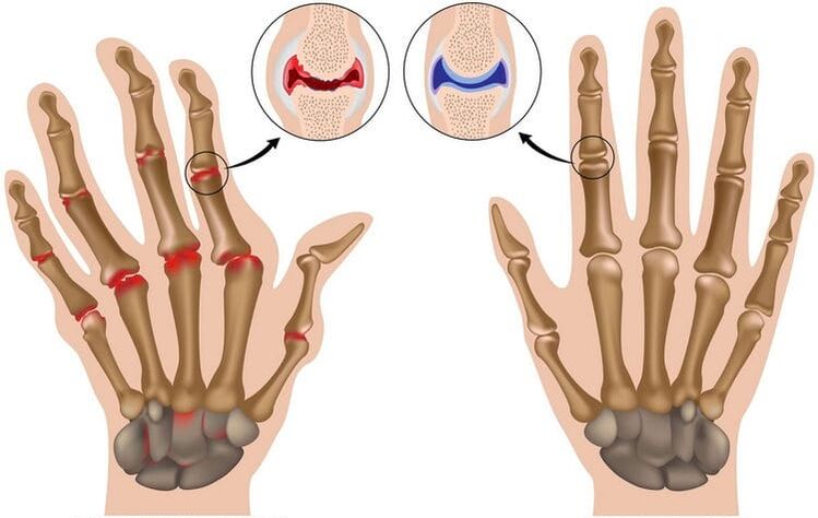 Healthy Hands and Joints damaged by arthrosis