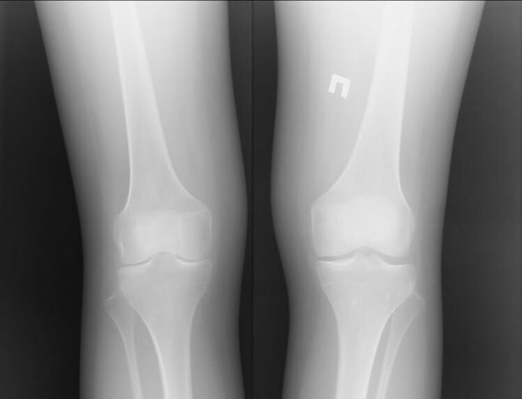 Knee x-ray affected by arthrosis