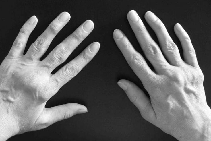 Symptoms of arthritis in the joints
