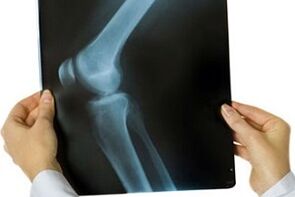 Knee joint arthrosis on x-ray